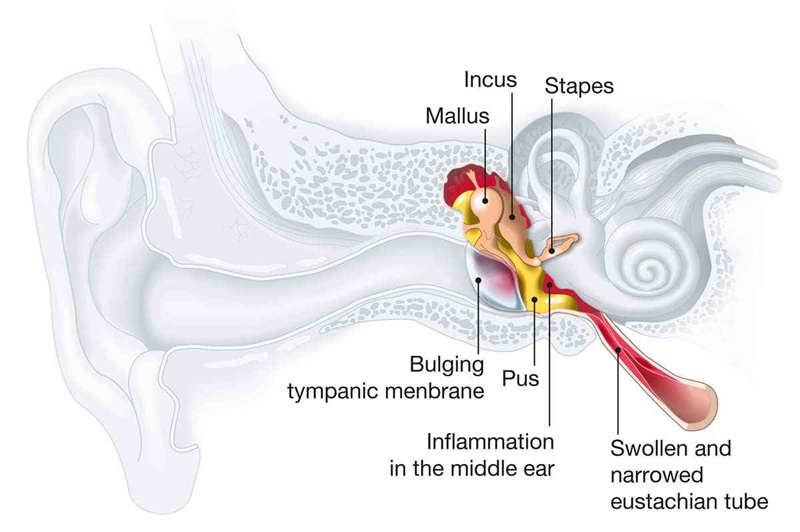 Middle Ear Infection