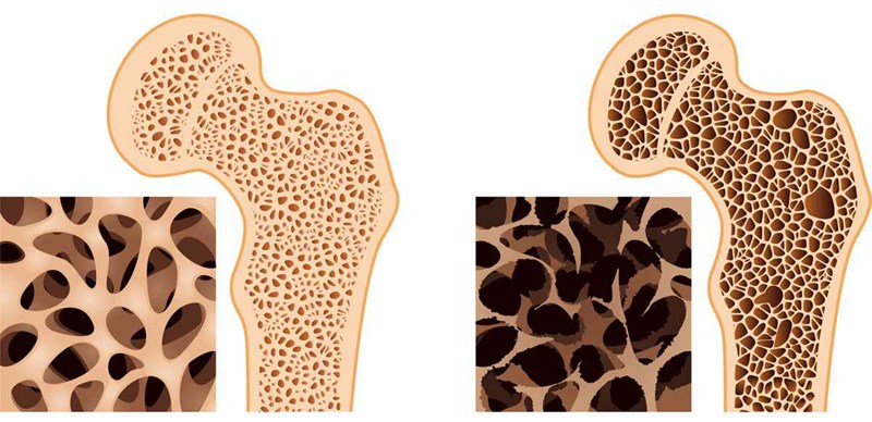Normal bone versus osteoporosis 