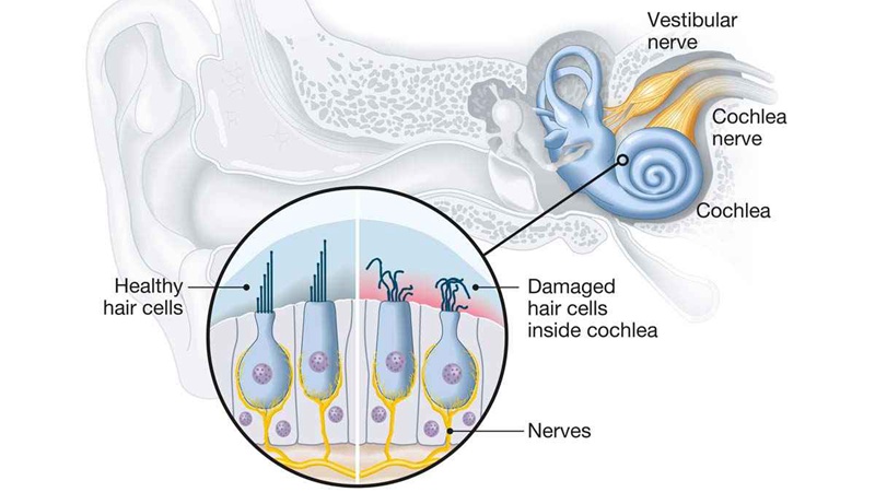 Sensorineural hearing loss, or SNHL, happens after damage to the hair cells within your inner ear (cochlea) or the nerve pathways from your inner ear to your brain.