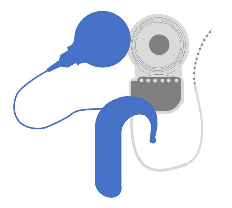 The exterior of the cochlear implant (blue) and internal components (grey) work together to deliver processed sound to the cochlear, or inner ear.
