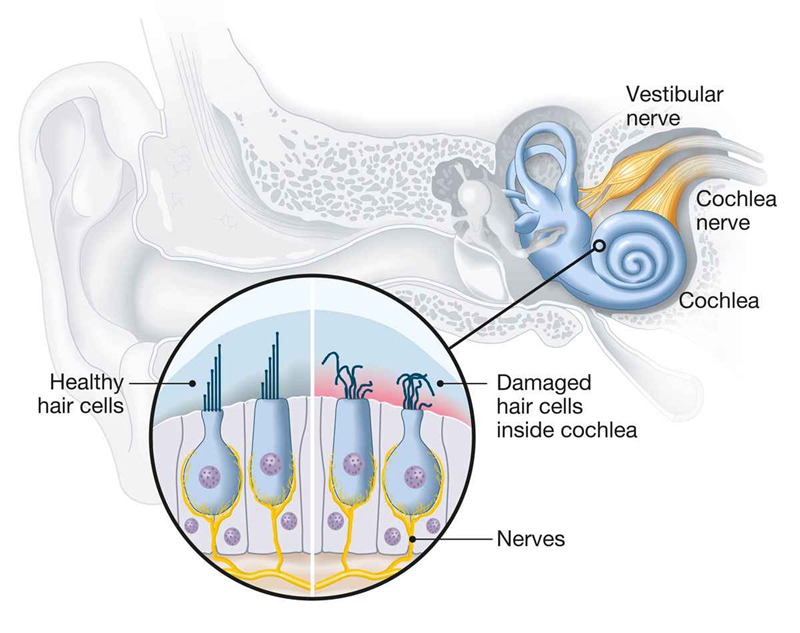 Hair cells inside the cochlea—the tiny organ about the size of a pencil eraser responsible for our hearing—can be damaged due to otoxicins and changes in the biochemistry of the inner ear. Likewise, the nerves that transmit sounds from the cochlea to the brain may also become damaged from certain chemotherapy drugs.