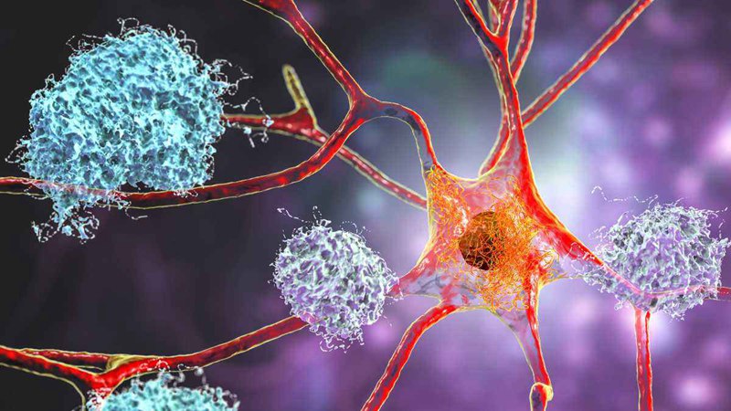 Alzheimers Nerve Cells Plaques