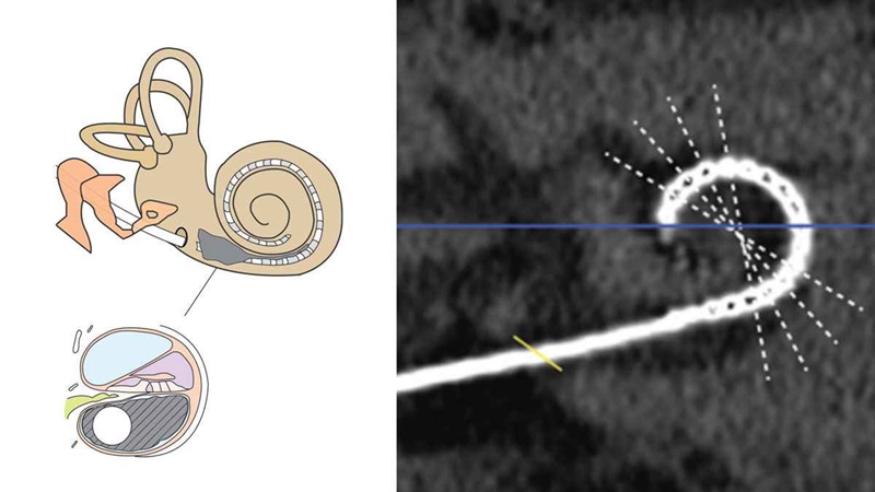 Cochlea Bone Growth