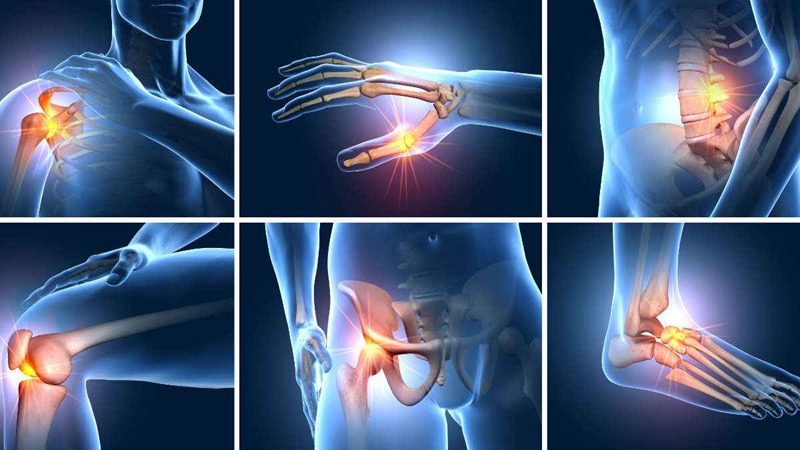 Inflammatory Arthritis Affected Joints