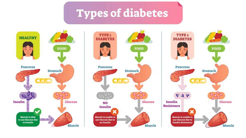 Insulin helps blood sugar enter the body's cells so it can be used for energy and also signals the liver to store blood sugar for later use. In people with type 1 diabetes, the pancreas makes little or no insulin; people with type 2 diabetes have bodies that are unable to use insulin properly.