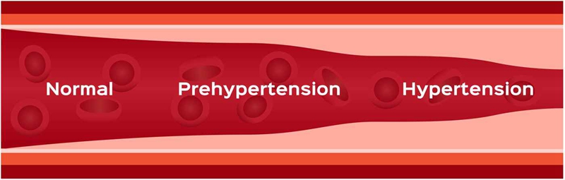 In hypertension, arteries become constricted, forcing the heart to pump blood with more force.