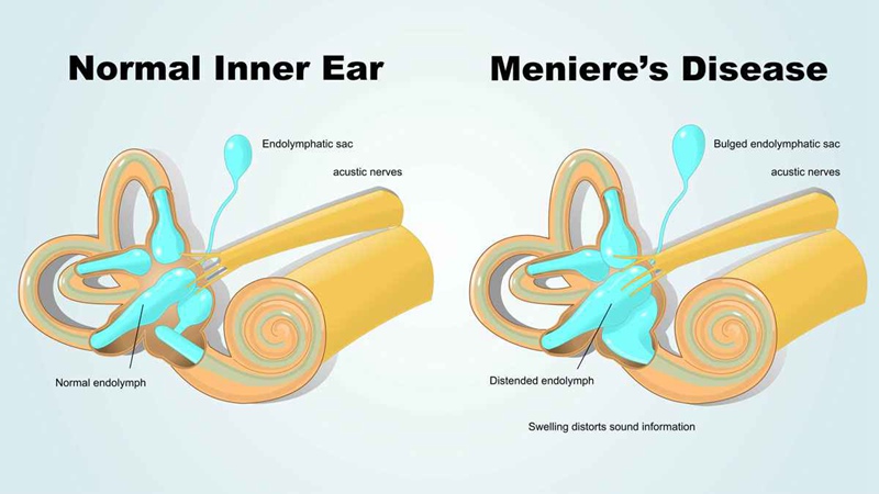 Menieres Diagram
