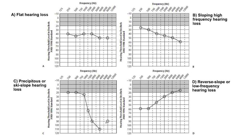 There are many different possible types of hearing loss configurations revealed by an audiogram. Four are shown above, with two common types (flat and sloping high frequency hearing loss) shown on top, and two less common types on the bottom.